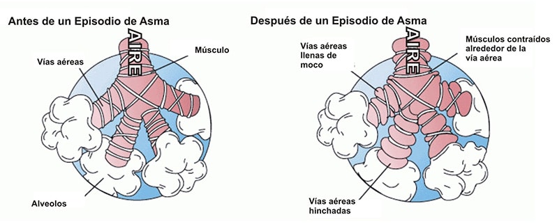 Enfermedades Aparato Respiratorio Asma