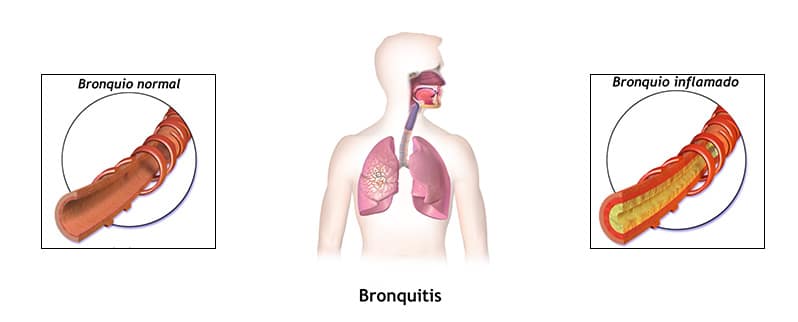 Enfermedades Aparato Respiratorio Bronquitis
